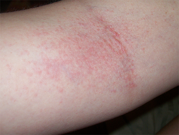 Rash on Elbows and Knees, Itchy, Inside Both, Red Rash ...