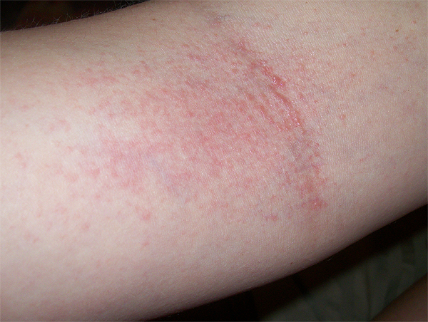 Rash In Arm Crease - Doctor answers on HealthTap